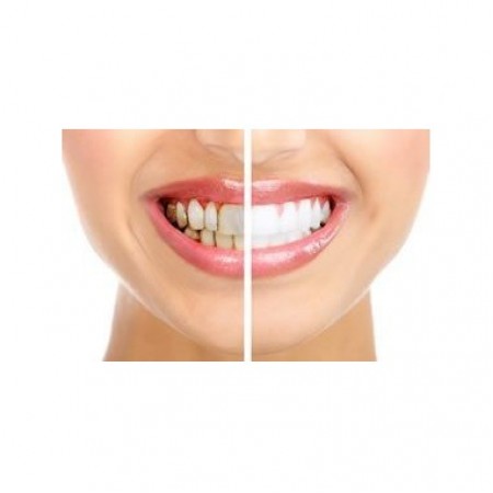 Albirea Dintilor Acasa - 4 Seringi Opalescence 16% 